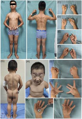 The Clinical, Myopathological, and Genetic Analysis of 20 Patients With Non-dystrophic Myotonia